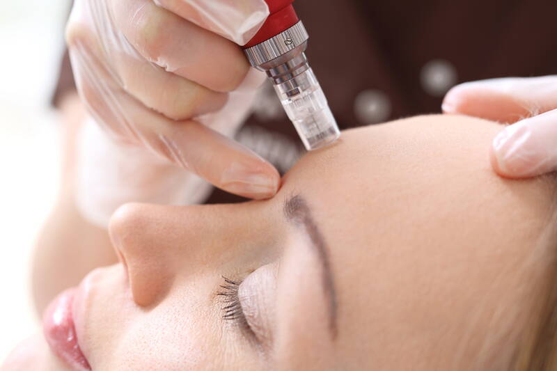 Micro-Needling